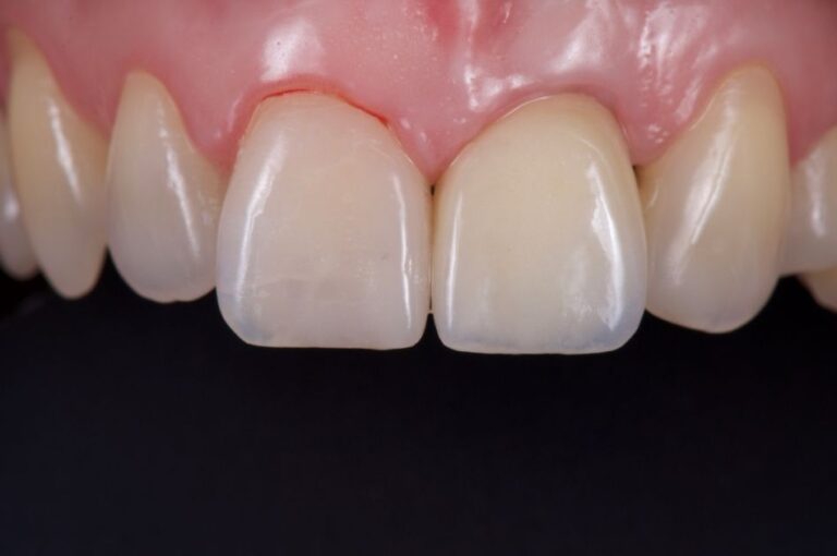 Composite Implants