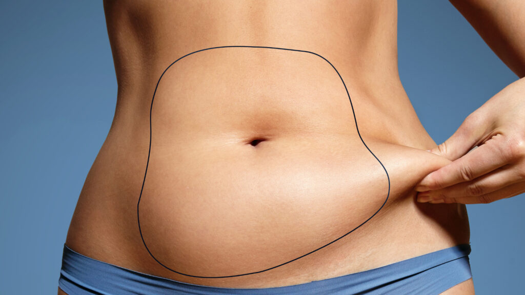 Stomach Liposuction