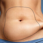 Stomach Liposuction