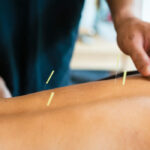 Acupuncture for Back Pain