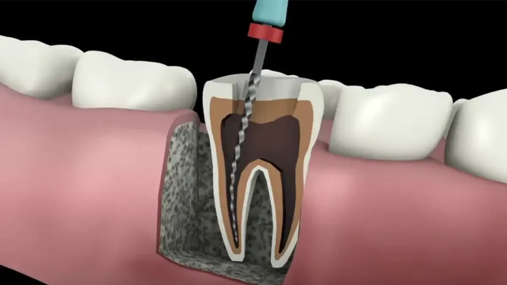 Root Canals – A Pain-Free Solution for Tooth Problems 