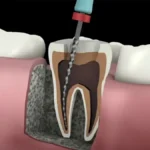 Root Canals – A Pain-Free Solution for Tooth Problems 