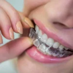 What Are the Benefits of Invisalign Over Traditional Braces?