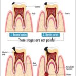 The Root Canal Process: A Step-by-Step Guide