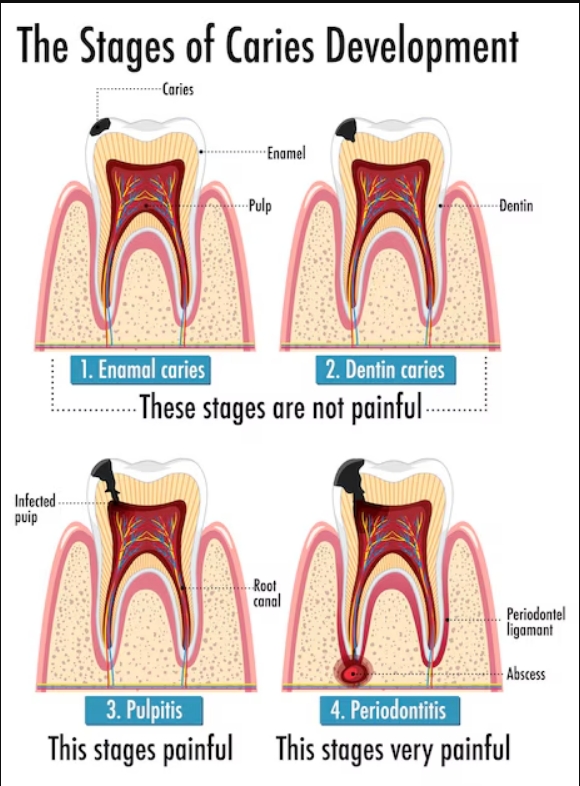 The Root Canal Process: A Step-by-Step Guide