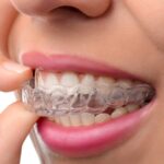 Benefits of Invisible Braces for Modern Smiles