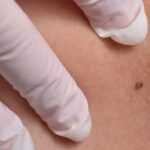 The Role of Skin Tags in Skin Health: When Removal is Necessary