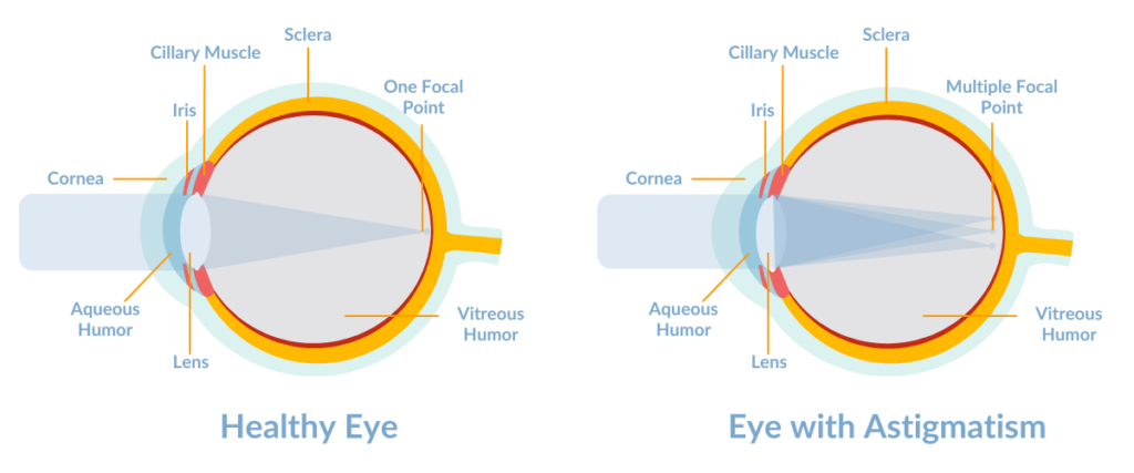 Correcting Astigmatism