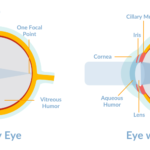 Correcting Astigmatism