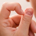 CBT for Dermatillomania: Effective Strategies for Managing Skin Picking Disorder