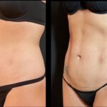 Tummy Tucks and Liposuctions