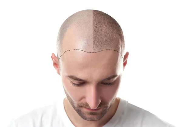 A Game-Changer for Hair Restoration