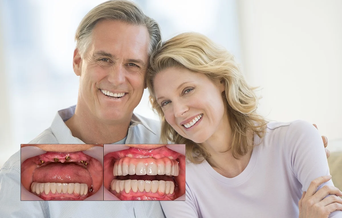 Dental Implant