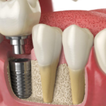 The Comprehensive Guide to Dental Implants