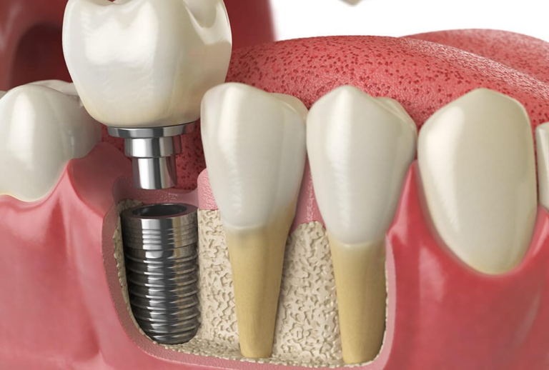 The Comprehensive Guide to Dental Implants