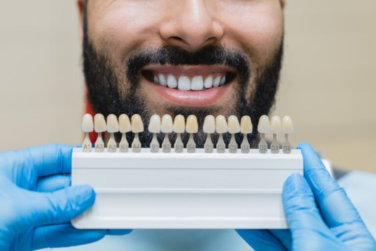 Snap-On Veneers vs Traditional Veneers