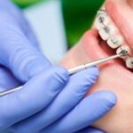 From Teen to Adult: The Lifelong Benefits of Orthodontic Treatment in Thornton