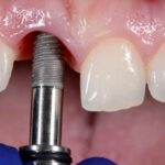 How to Prepare for Your Dental Implant Surgery: A Step-by-Step Guide