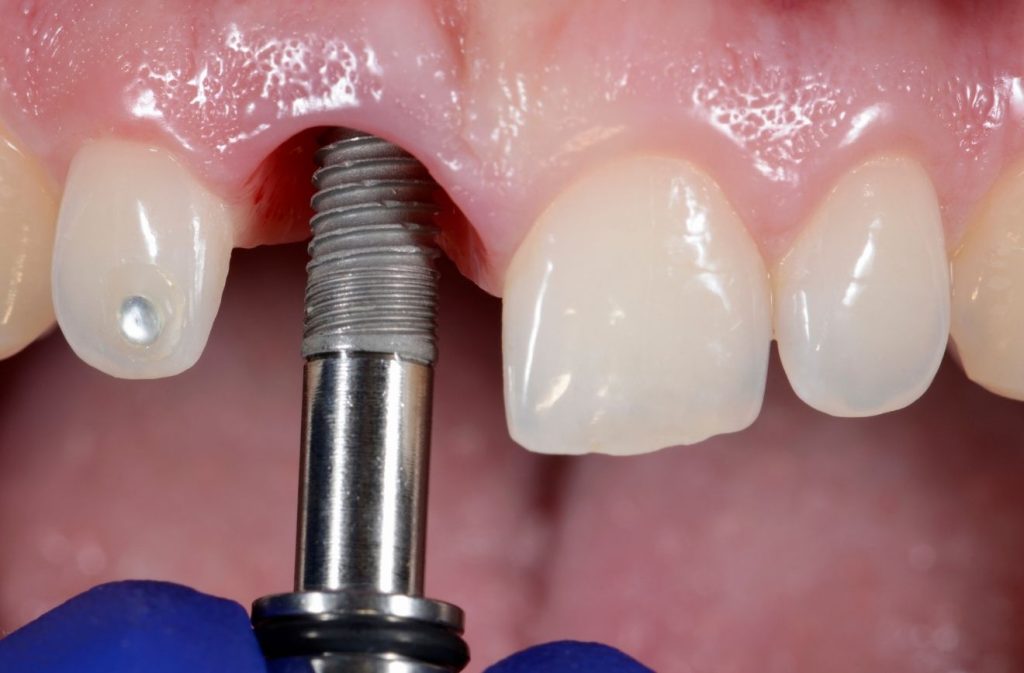 How to Prepare for Your Dental Implant Surgery: A Step-by-Step Guide