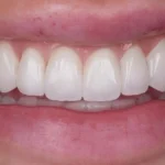 Dental Flipper Cost vs. Best Veneers Online: What Women Are Choosing