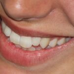 From Crooked to Confident: Teeth Straightening Options in Cary