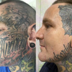 Before and After: The Impact of Tattoo Removal