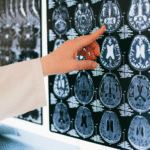 Essential Recovery Tips Following a Brain Injury