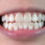 From Stains to Smiles: How a Pediatric Dentist in Denver Treats White Spots