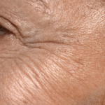 How CO2 Laser Targets Sun Damage and Deep Wrinkles