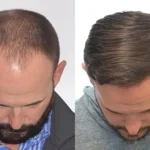The Role Of FUE And FUT In Hair Transplant Repair