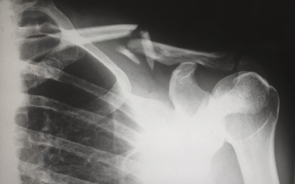 Reasons Why You're Experiencing Shoulder Pain