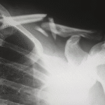 Reasons Why You're Experiencing Shoulder Pain