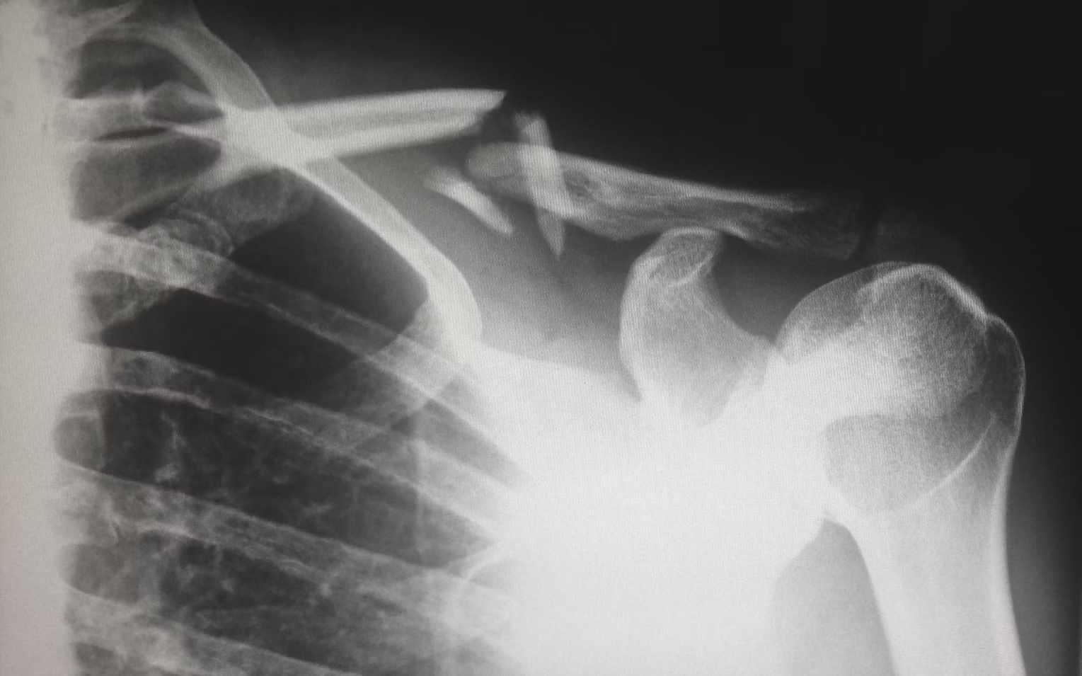 Reasons Why You're Experiencing Shoulder Pain