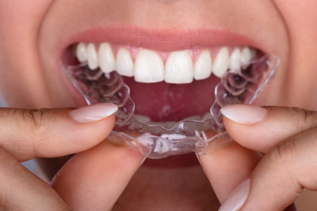 Invisalign Cost