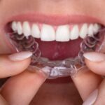 Invisalign Cost
