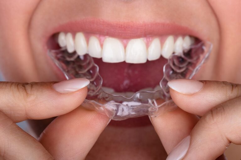 Invisalign Cost
