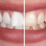 Teeth Whitening
