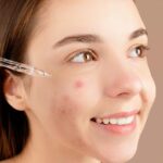 Centella Asiatica for Acne