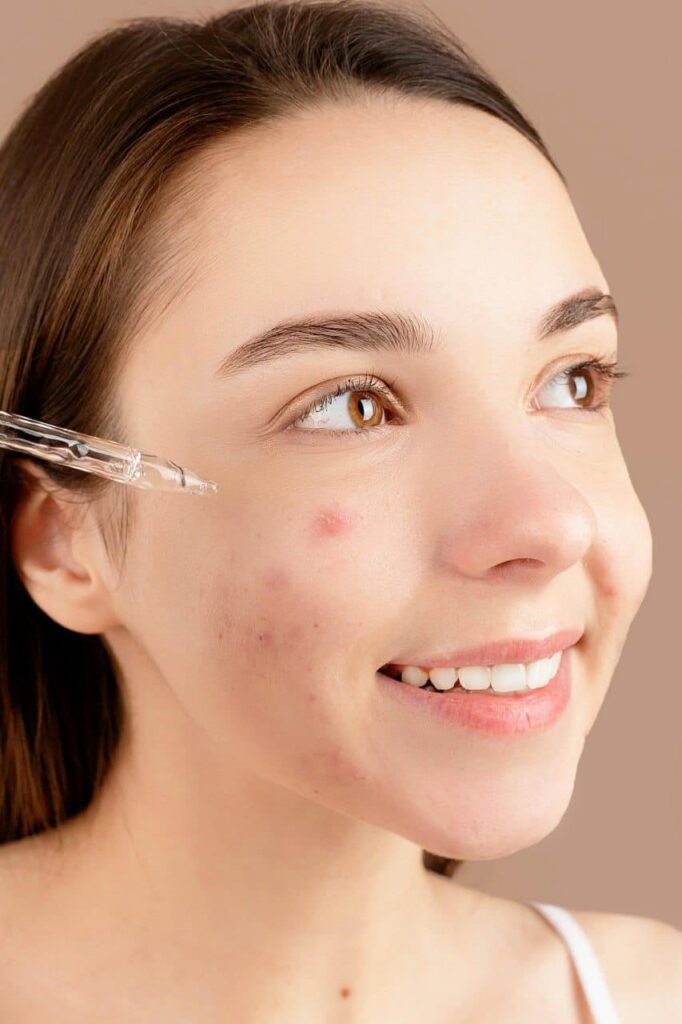Centella Asiatica for Acne