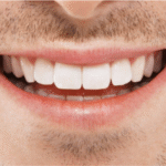 Dental Implants: A Permanent Solution for Missing Teeth