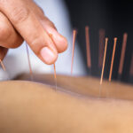 acupuncture