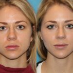 How Jawline Filler Enhances Facial Definition