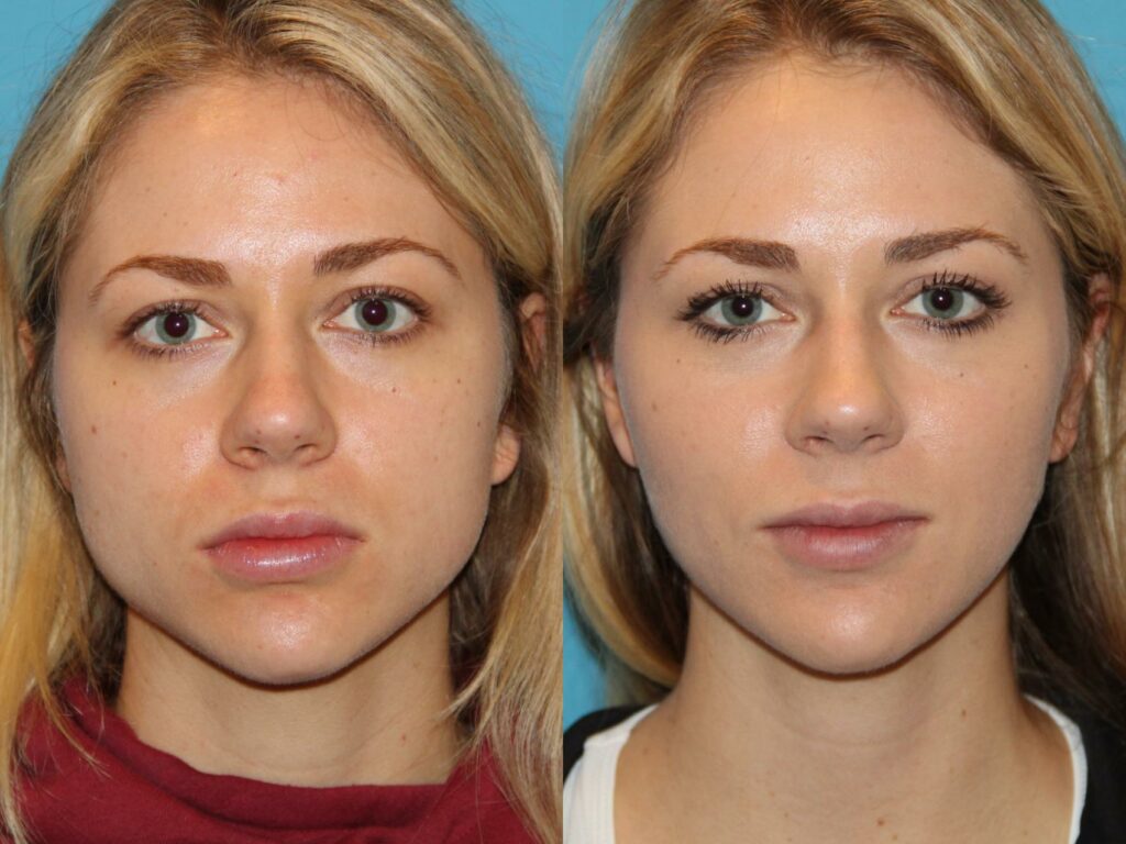 How Jawline Filler Enhances Facial Definition