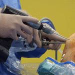 Knee Replacement Surgery