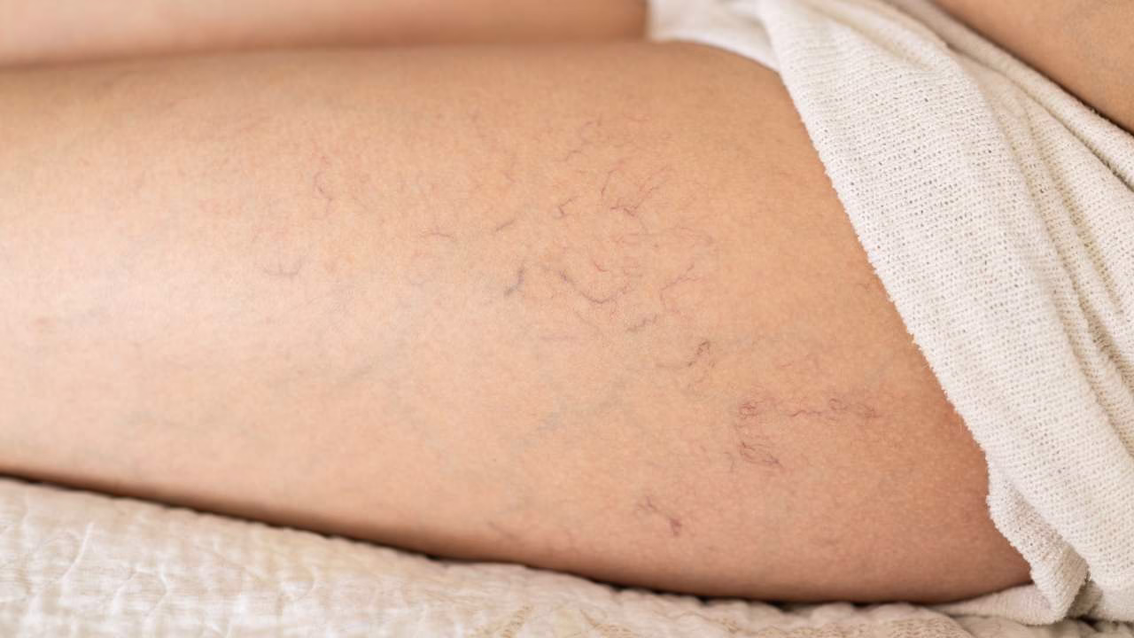 Spider Veins