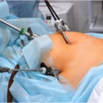 Why Hernia Removal Surgery Changes Lives for the Better