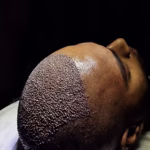 What Age is Best For a Hair Transplant?