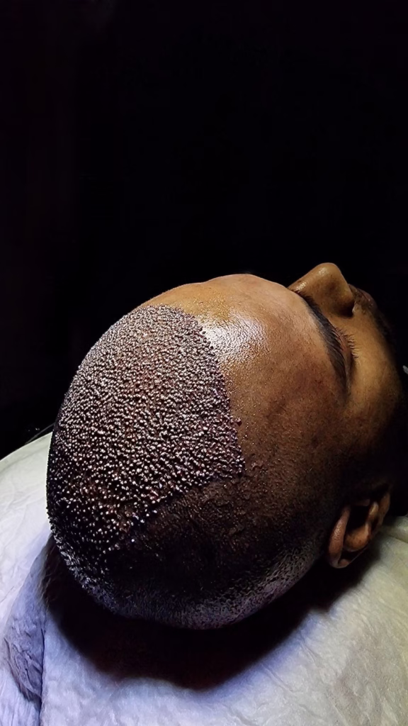 What Age is Best For a Hair Transplant?