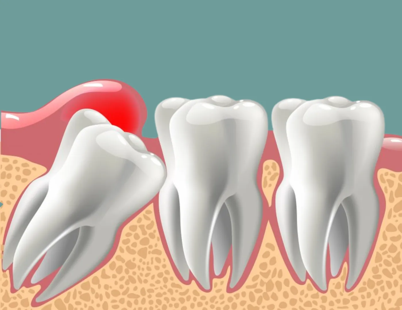 Wisdom Tooth Pain