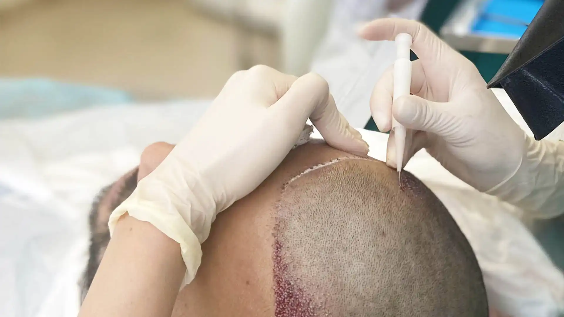 Hairline Restoration in Greece: Procedure, Cost, and Natural Results